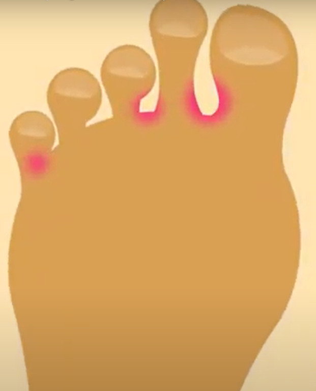 Athlete's Foot in Adults Keeping Me Well