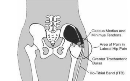 Diagram showing the area of pain in lateral hip pain. On the side of the hip.