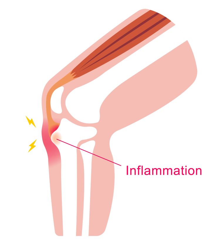 osgood-schlatter-disease