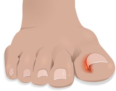 Ingrown toe-nail